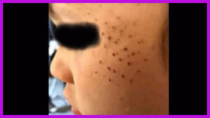 تعرض طفلة لوخز بالإبر على وجهها